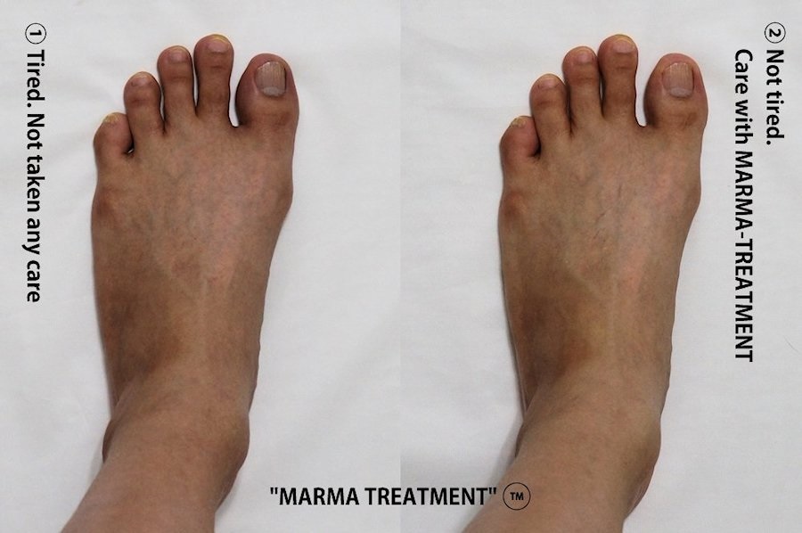 foot care with marmatreatment